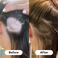 HAIR BURST Biotin Gummies for Hair Growth - Hair, Skin & Nails Vitamin Supplement, Reduces Breakage, Promotes Healthier Thicker Hair - Daily Chewable Vitamins - 1 Month