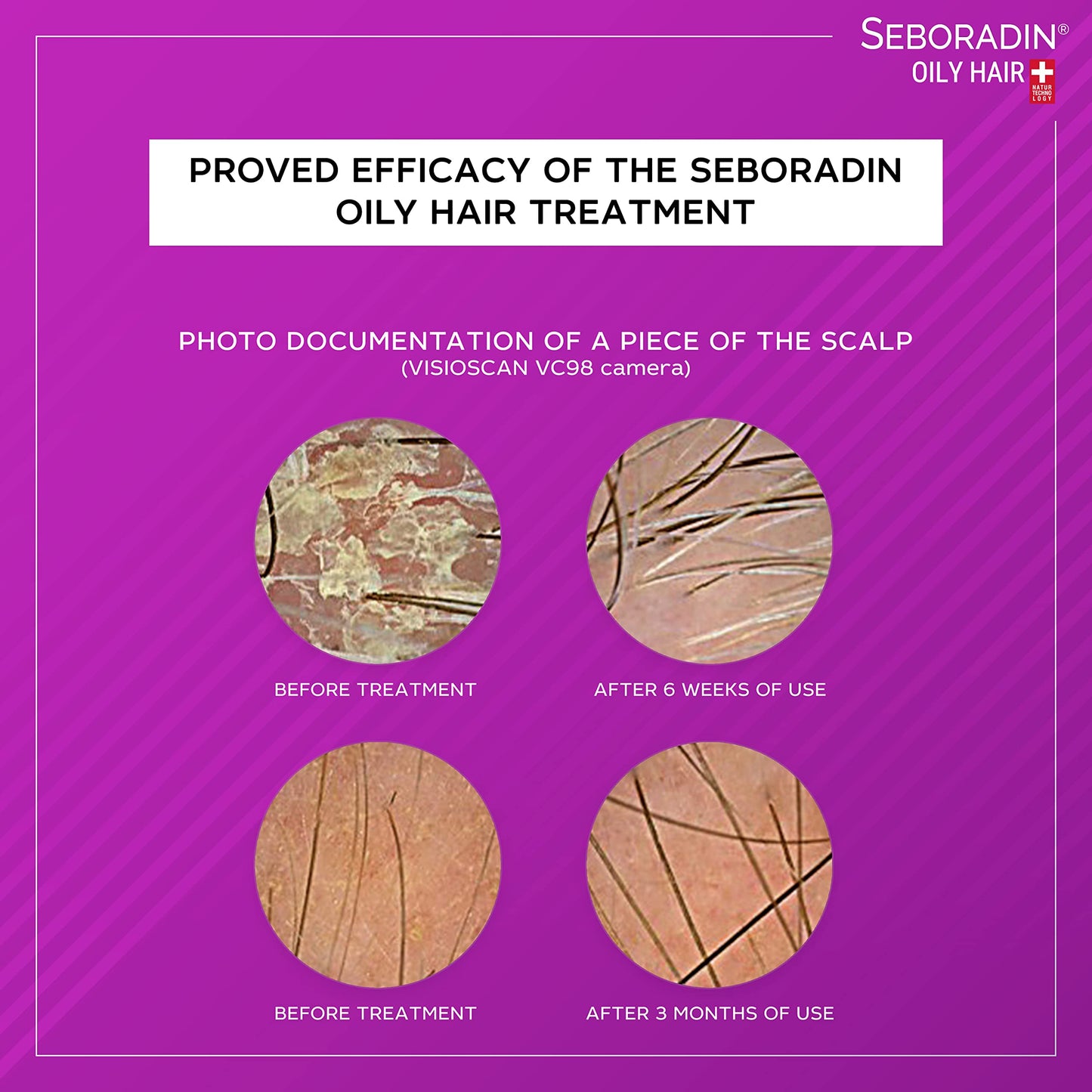 SEBORADIN OILY HAIR Serum Ampoules 14 x 5,5 ml Anti Hair Loss Serum Chronic Hair Loss and Thinning Treatment Natural Extracts and Vitamins Hair & Scalp Treatment Hair Care & Products