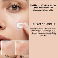 Golden Future Anti-Acne Revitalising cream , Targeted spot Treatment , pimple reducer with precision Applicator 20g