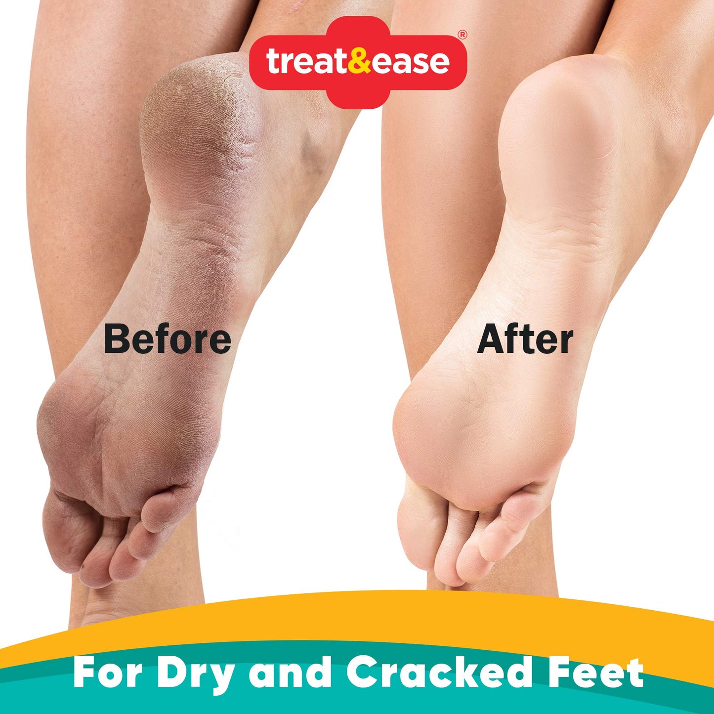 2pk Moisturising Foot Cream for Cracked Heels and Dry Skin | 200g | Dry Foot Cream for Very Dry Feet & Cracked Heel Repair Cream | Heel Balm for Cracked Heel Cream, Foot Balm Feet Cream + SOL Sticker