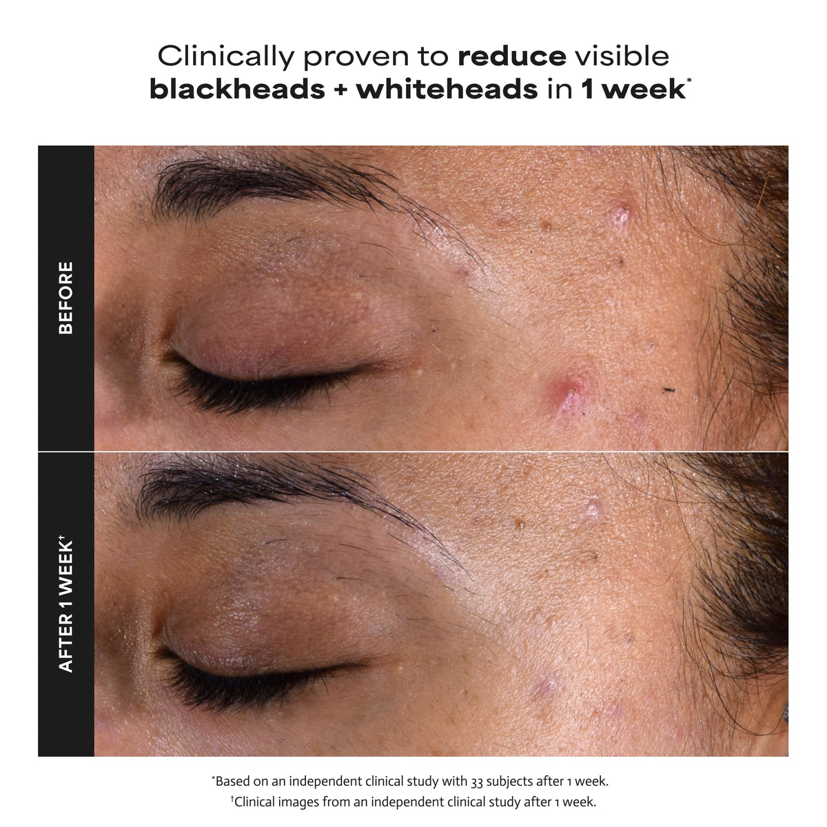 PAULA'S CHOICE Paula's Choice 2% BHA Liquid Face Exfoliant for Blackheads & Pores, 30 ml