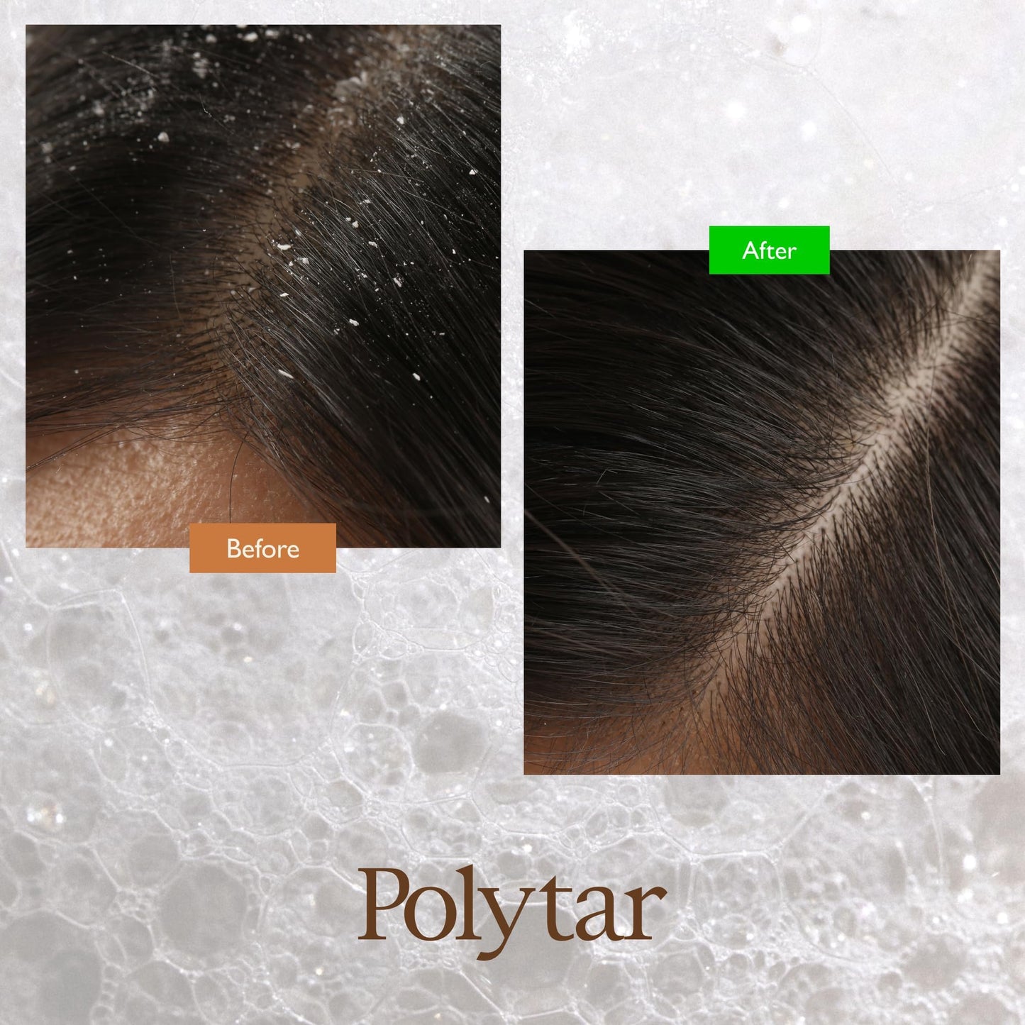 Polytar Scalp Shampoo, For Scalp Conditions, Reduces Itching, Inflammation and Scales, Shampoo Treats Psoriasis, Seborrhoeic Dermatitis, Eczema and Dandruff, Contains Coal Tar Solution, 1 x 150ml