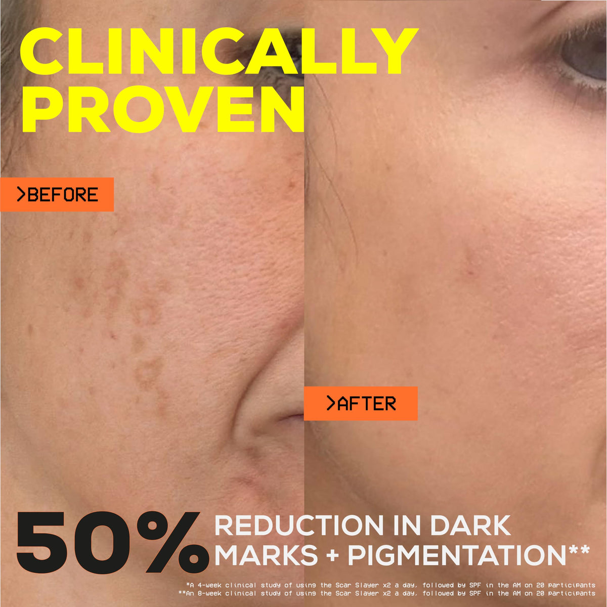 Glow Hub The Scar Slayer Facial Serum with Vitamin C for Anti-Pigmentation and Blemish Prone Skin 30ml