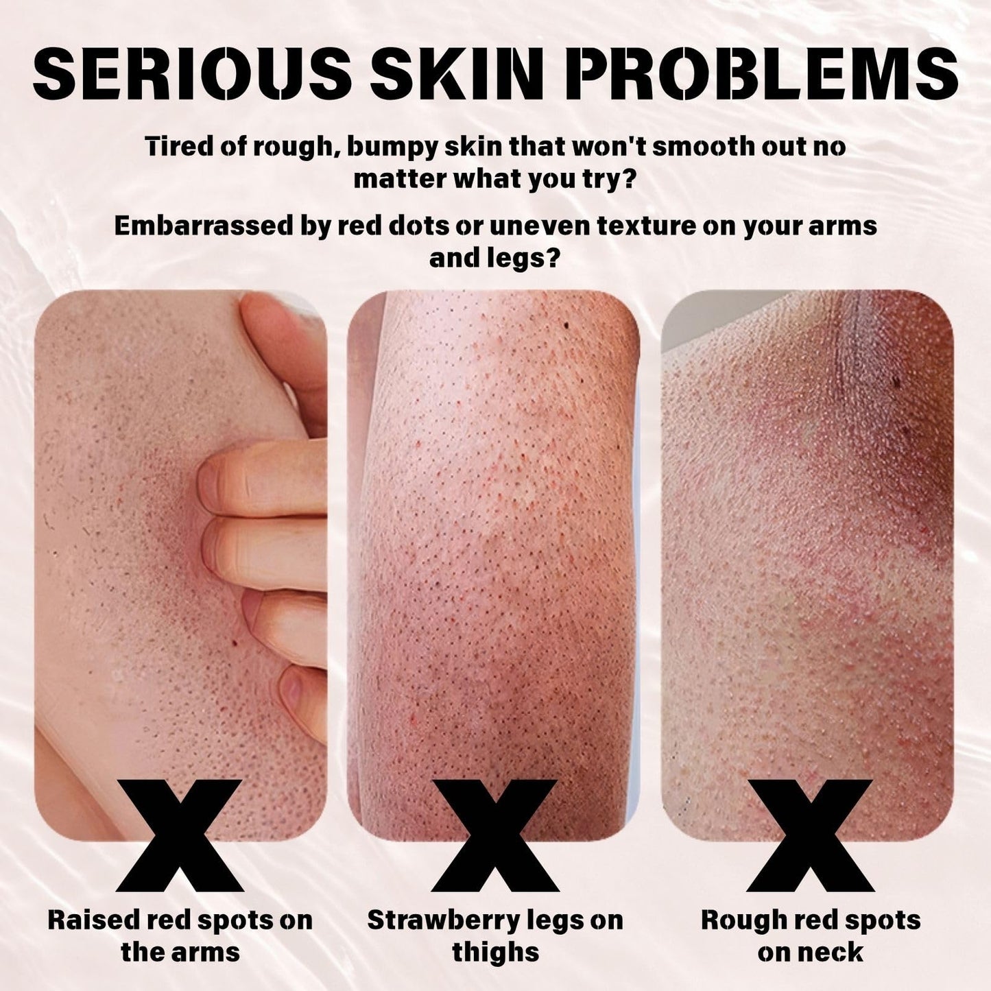 Strawberry Legs Treatment Cream – Body Cream for Strawberry Skin, Dry Skin Moisturiser with Exfoliating & Smoothing Formula, Foot Product for Very Dry Feet, Body Skin Care Lotion for Women & Men