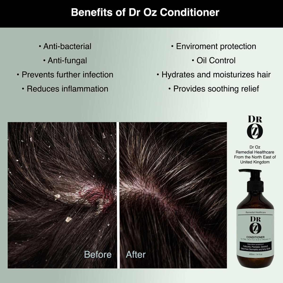 Dr Oz Conditioner with Tea Tree, Salicylic Acid and Oregano Oil. Helps Relieve Symptoms of Folliculitus, Psoriasis, Dandruff, Seborrheic Dermatitis and Itchy Scalp.