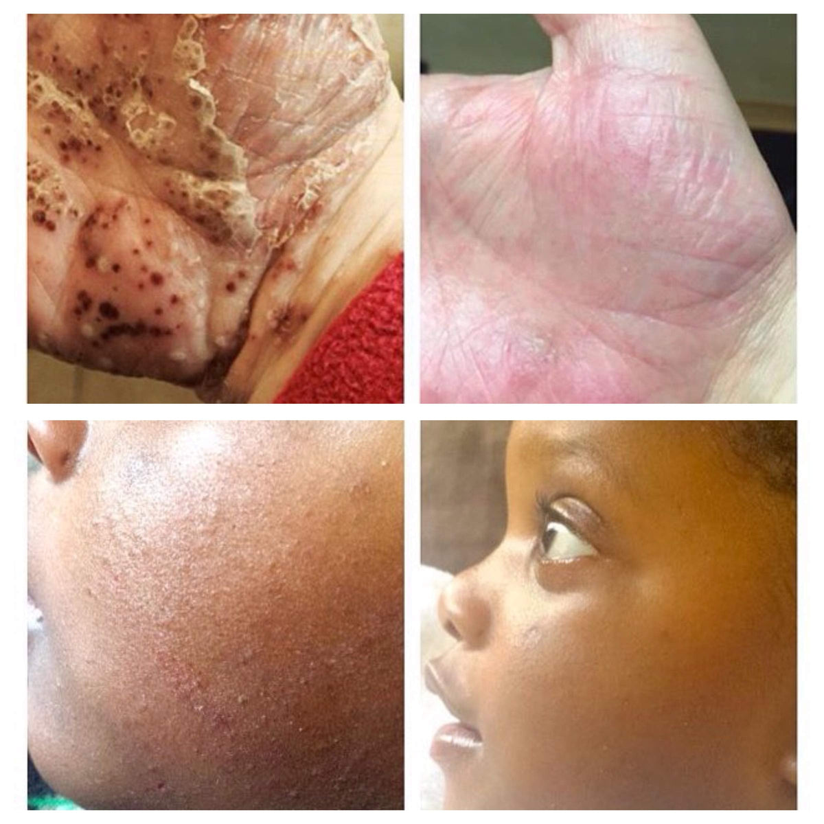 Bria Eczema Cream for dry, sensitive skin prone to eczema and psoriasis. Suitable for baby, children and adults. Fragrance free, natural and organic itch relief