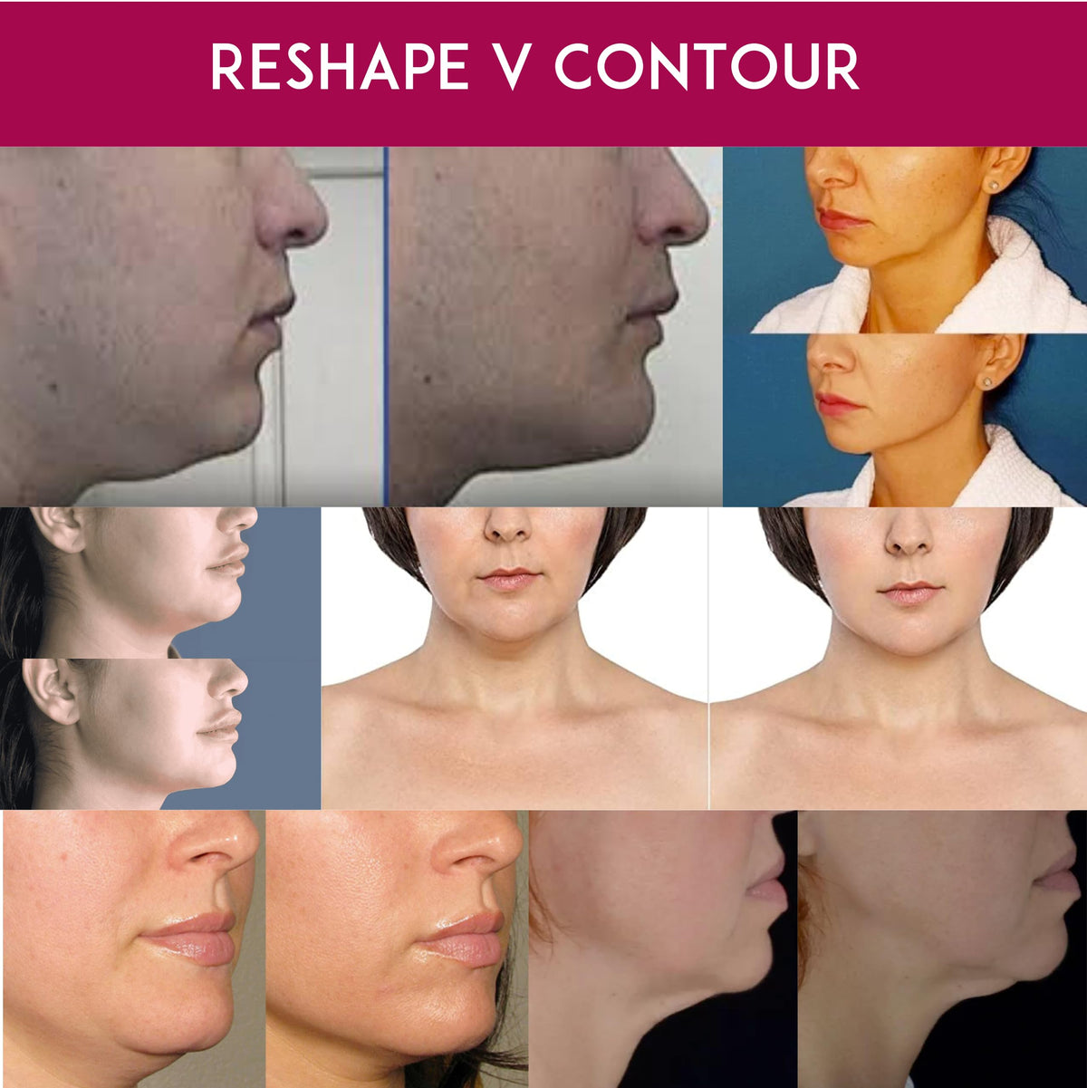 Anacis Double Chin Reducer Neck Loose Sagging Skin Lifting Tightening Firming Face Shaping. Vela Contour (CREAM)