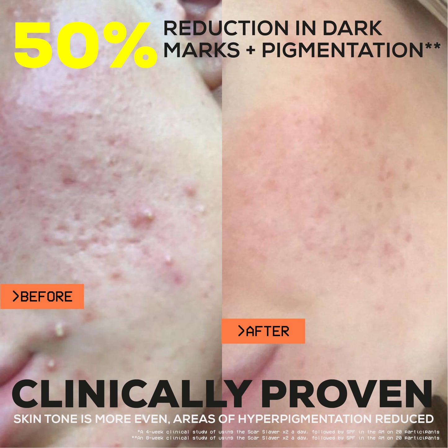 Glow Hub The Scar Slayer Facial Serum with Vitamin C for Anti-Pigmentation and Blemish Prone Skin 30ml