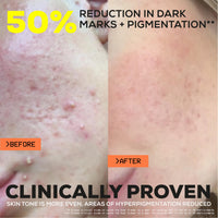Glow Hub The Scar Slayer Facial Serum with Vitamin C for Anti-Pigmentation and Blemish Prone Skin 30ml