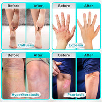 NYSA-9 Ultra-Hydrating 40% Urea Foot Cream 250 ml/8.5oz Plus 0.5% Salicylic Acid for Dry, Cracked Feet, Heels & Hands, Intensive Moisturizer & Skin Barrier Repair for Calluses & Psoriasis by Nysa-9