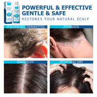 Roycederm Seborrheic Dermatitis Shampoo – Psoriasis, Dandruff & Folliculitis Care – Scalp Treatment for Itch, Flakes & Irritation