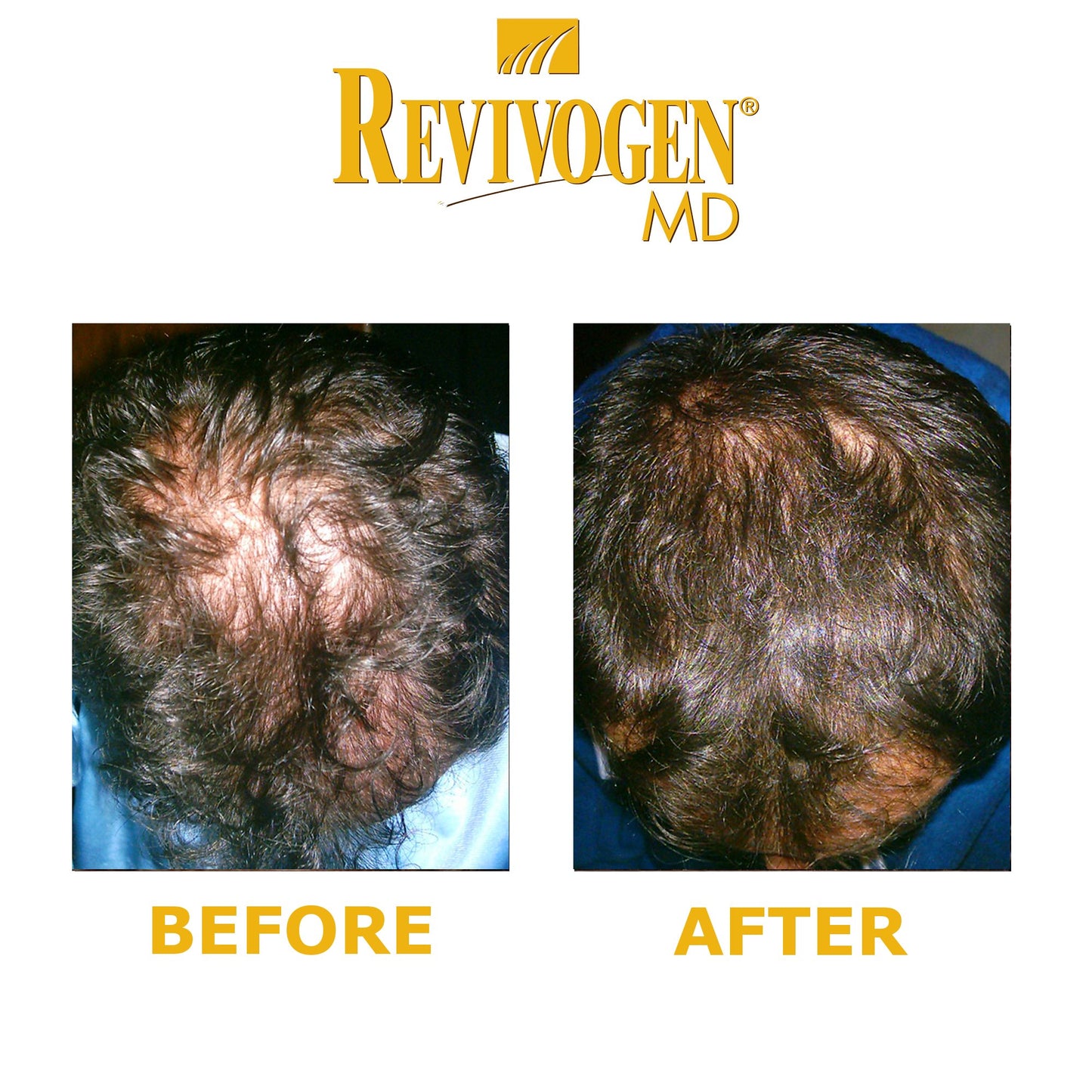 Revivogen REVIVOGEN MD Scalp Therapy. Natural Hair Loss Solution for Fine & Thinning Hair.