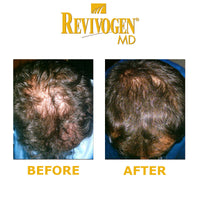 Revivogen REVIVOGEN MD Scalp Therapy. Natural Hair Loss Solution for Fine & Thinning Hair.